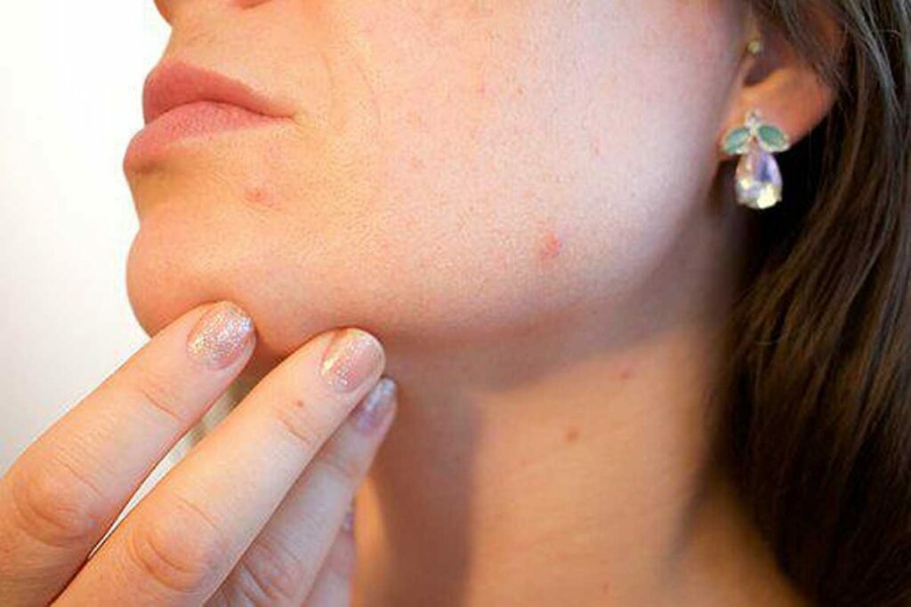 what is cellulitis