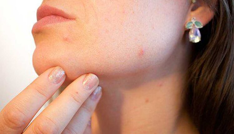 what is cellulitis