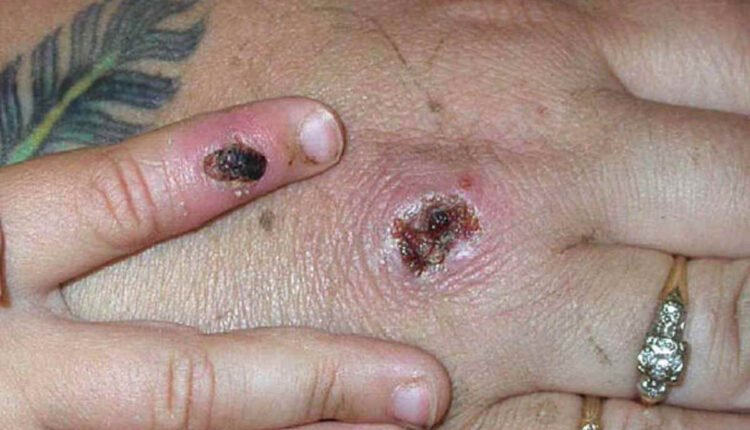 mono symptoms